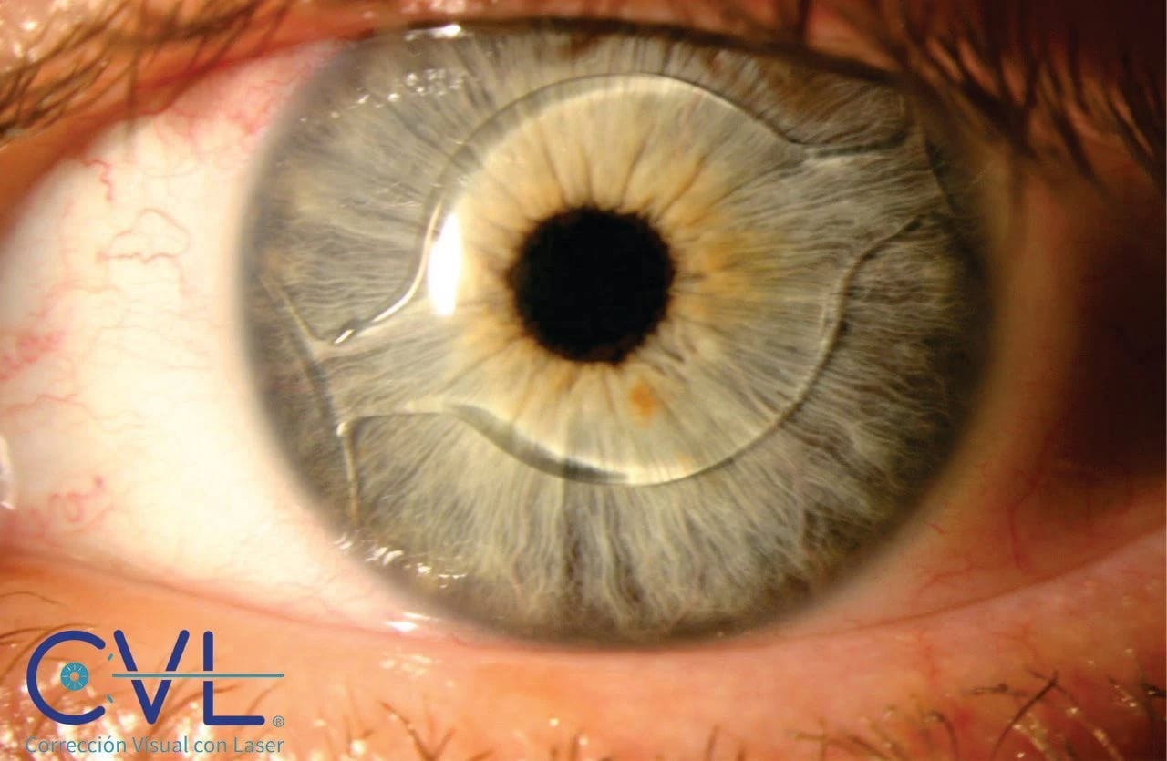 CVL Laser - Image 6